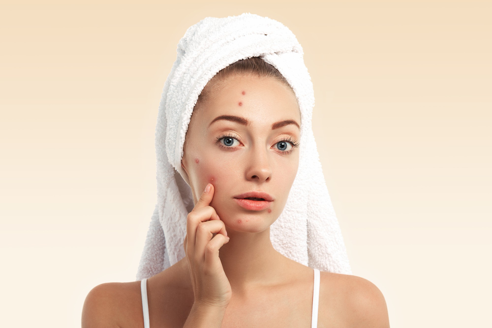 closeup young woman with towel head pimples face